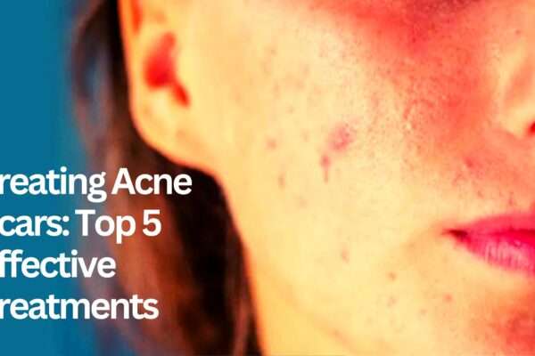 acne scar treatment