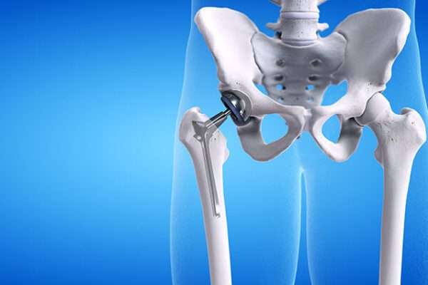 hip replacement surgeon