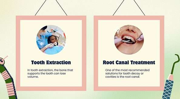 root canal