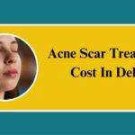 acne scar treatment